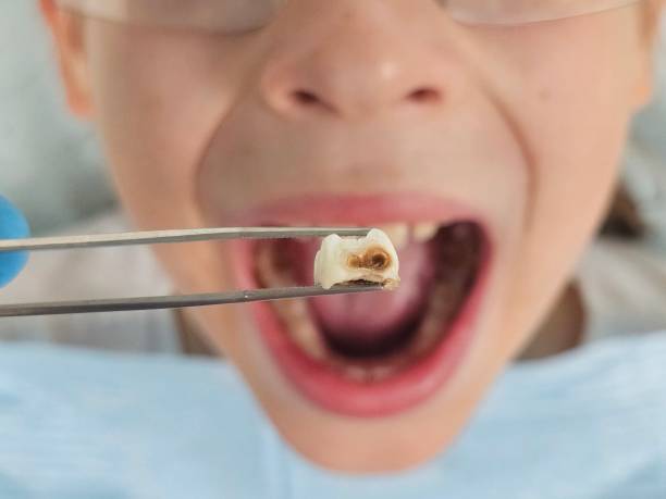 Tooth Infection Emergency Dentist in IL